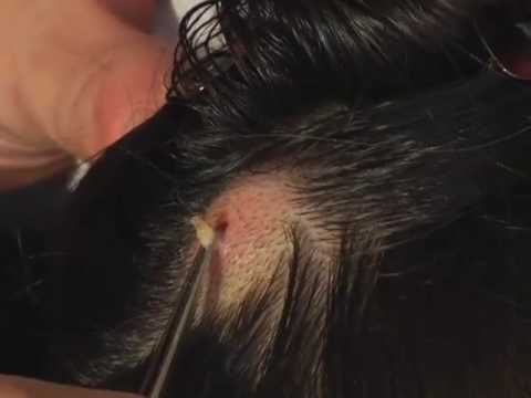 1 shocking moment in her life – Botfly larva in a girl’s head