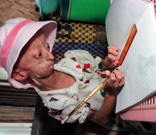 The Real Life Benjamin Button Kids