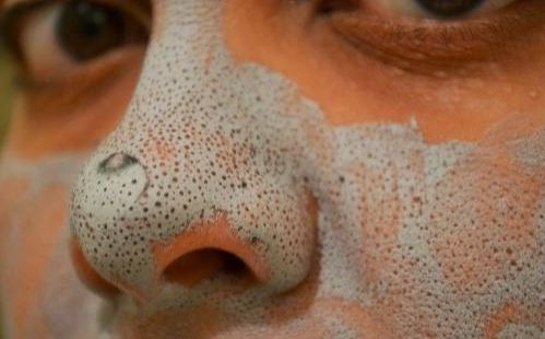 Some Easy Ways To Get Rid Of Blackheads