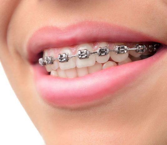 How to Survive Teeth Braces especially if You are a Teenager How to Survive Teeth Braces, especially if You are a Teenager