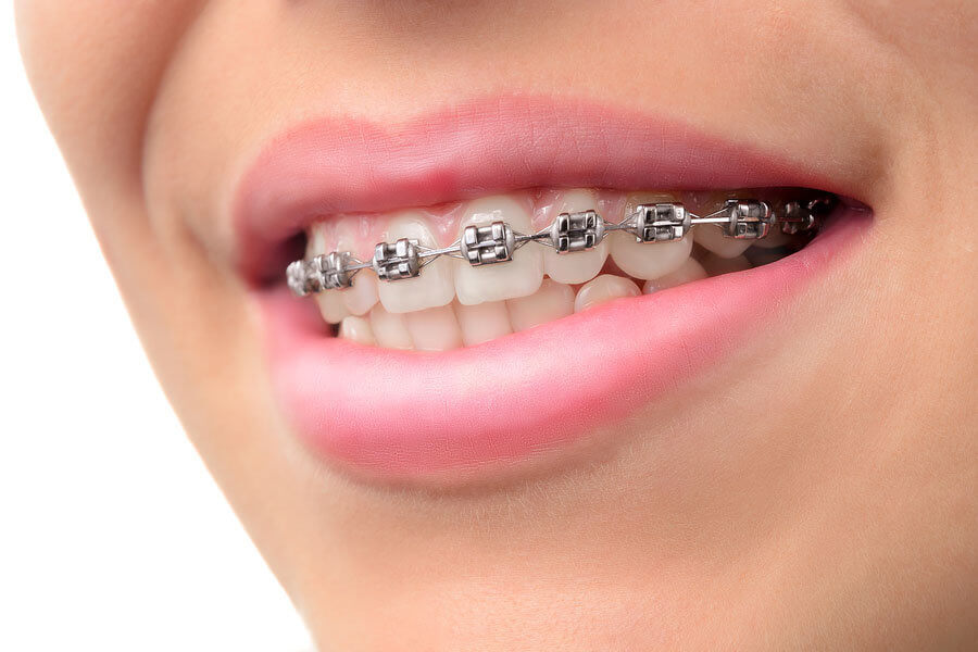 How to Survive Teeth Braces especially if You are a Teenager