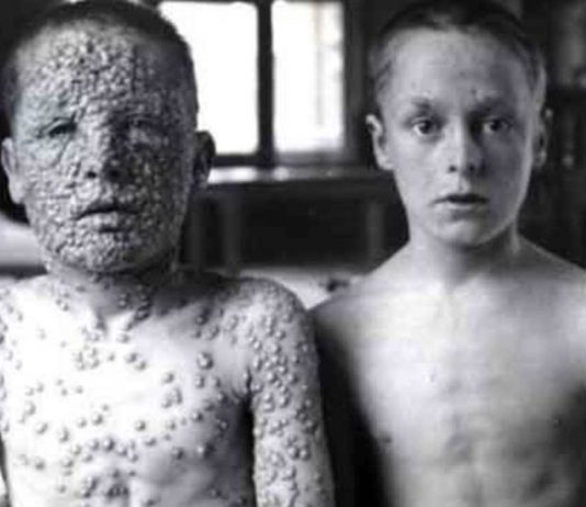 Deadliest Diseases Of World History: 5 Illnesses Deadliest diseases of world history