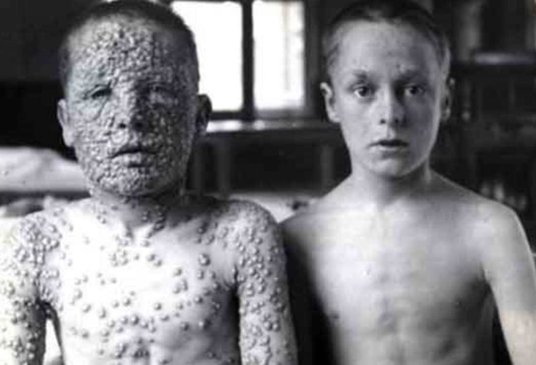 Deadliest Diseases Of World History: 5 Illnesses