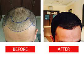 Top 5 Hair Transplant Clinics in Turkey
